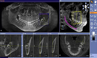 インプラントを正確な位置で埋め込む三次元画像解析「歯科用CTスキャン」を採用