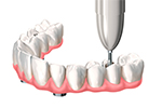 インプラントが、そんなあなたのお悩みを解決できます