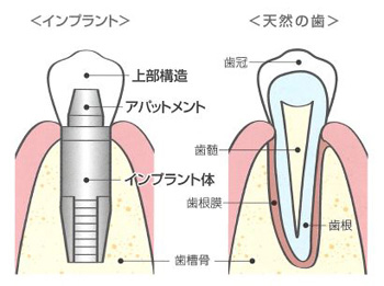 インプラントの構造